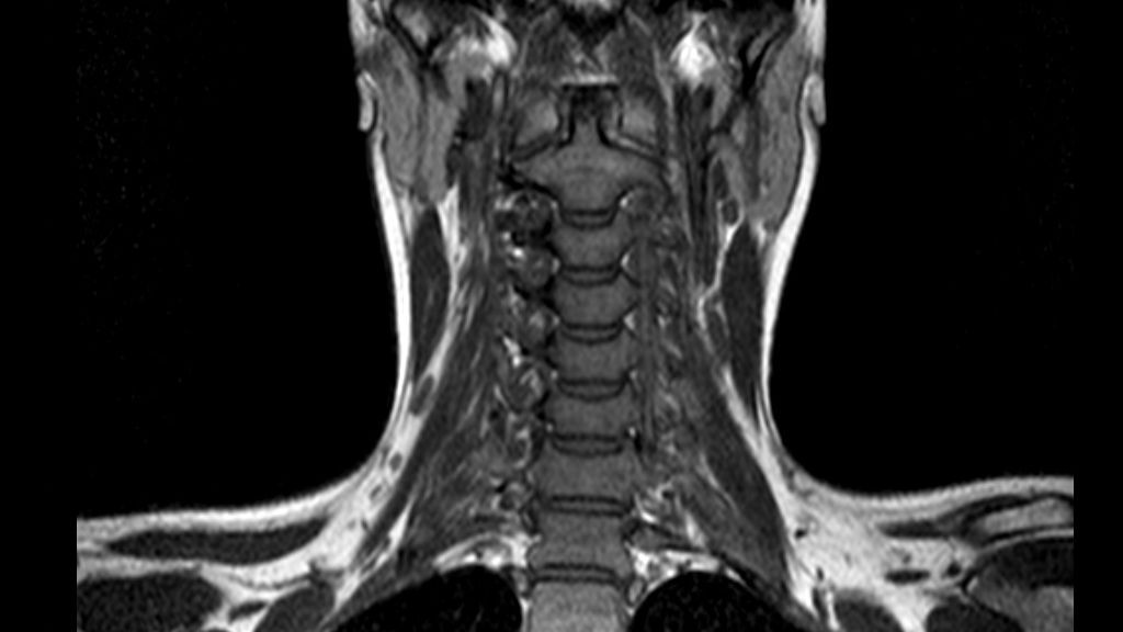 Мрт шейного отдела позвоночника здорового человека фото