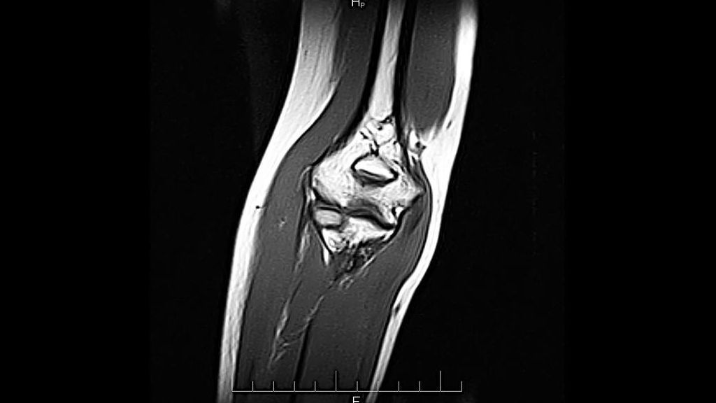 Мрт локтя. Патология локтевого сустава на мрт. Мрт локтевого сустава норма. Эпикондилит локтевого сустава мрт. Артрит локтевого сустава мрт.