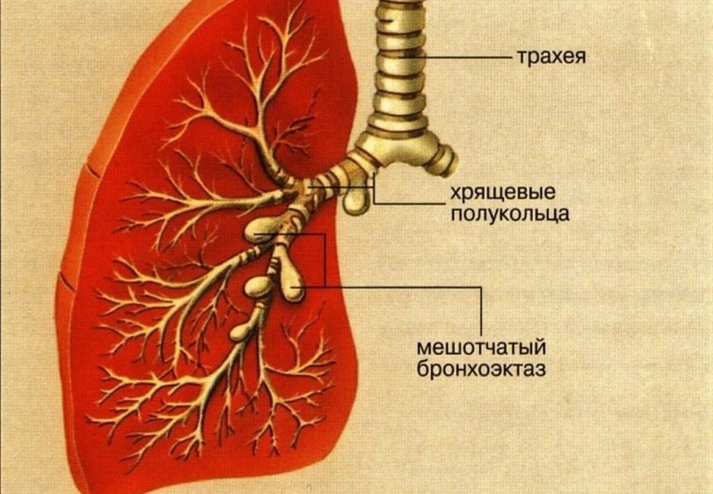 Бронхи фото где. Бронхоэктатическая полость. Бронхи и легкие. Бронхи и легкие расположение. Тракционные бронхоэктазы.