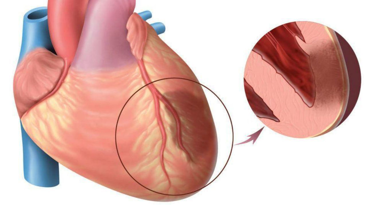 Экстренные операции при инфаркте миокарда