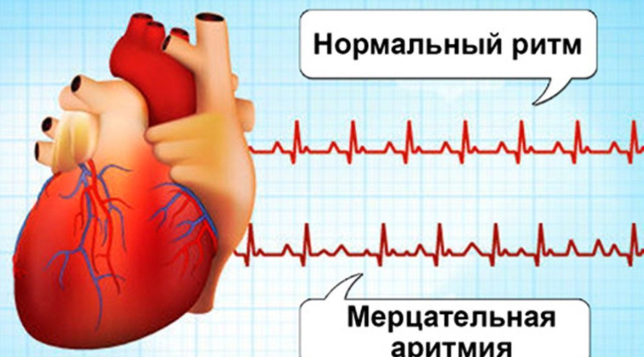 Как лечить мерцательную аритмию сердца современные препараты для лечения