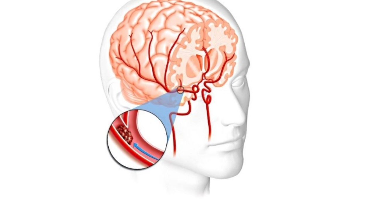 Дисциркуляторной энцефалопатии головного мозга у взрослых что. Дисциркуляторная энцефалопатия синдромы. Алкогольная энцефалопатия поражение мозга. Сосудистая энцелофапатия. Алкогольная энцелофапатия головного мозга что это такое.