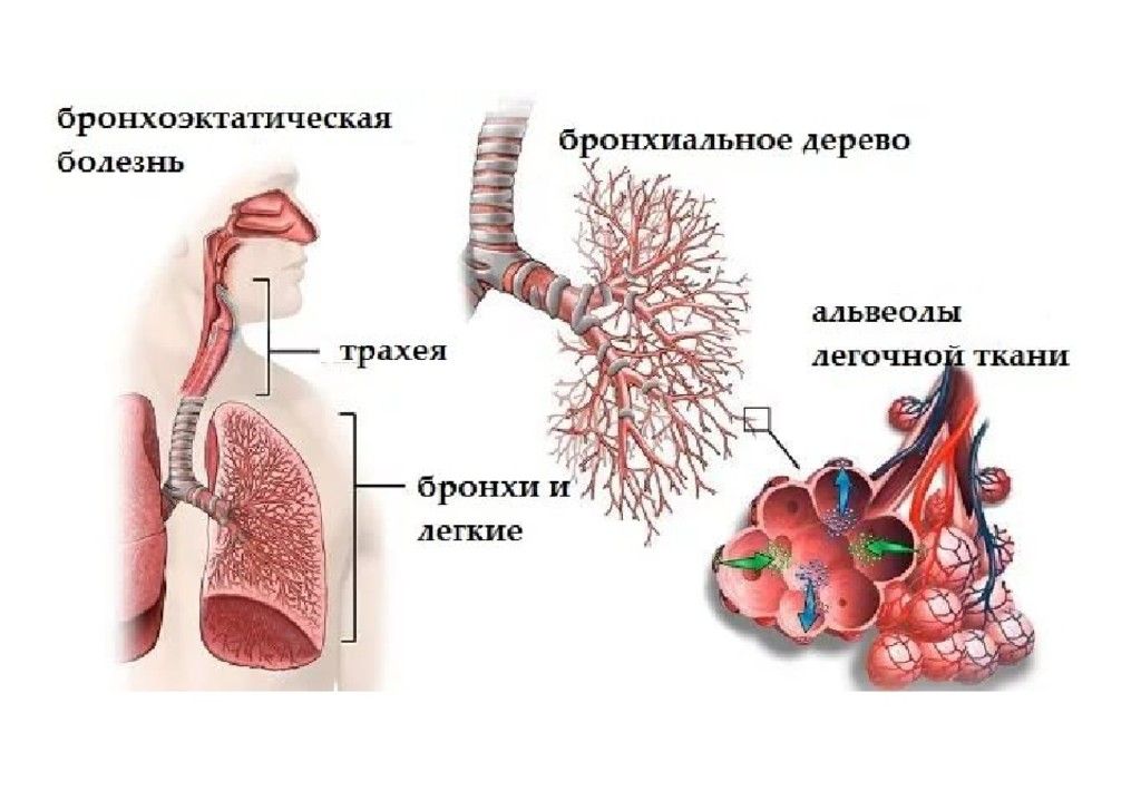 Бронхоэктатическая болезнь картинки